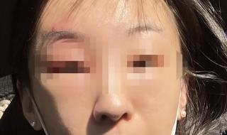 女子挤痘痘致脸部感染 女子挤痘痘致脸部感染